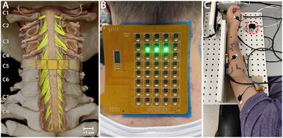 Targeted transcutaneous spinal cord stimulation promotes persistent recovery of upper limb strength and tactile sensation in spinal cord injury: a pilot study